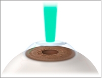 diagram of PTK for Lasik