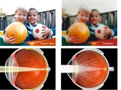 comparing normal vision with cataract vision