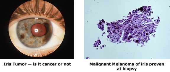 diagram of malignant melanoma for ophthalmic pathology