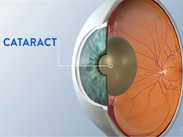 Cataract