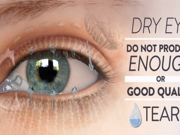 Dry Eyes