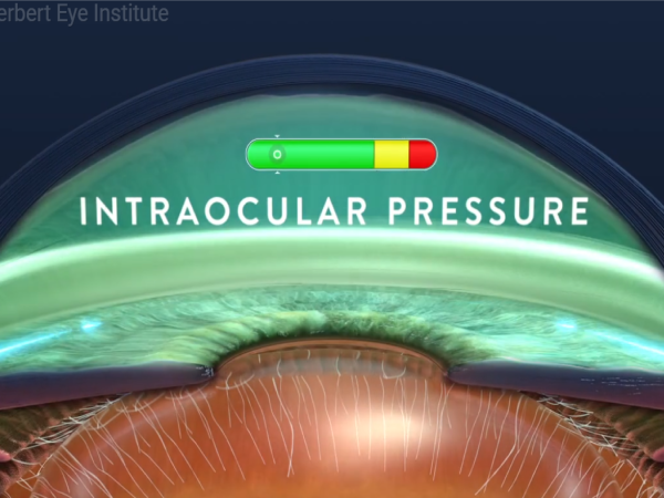 Glaucoma
