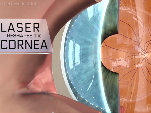 Lasik