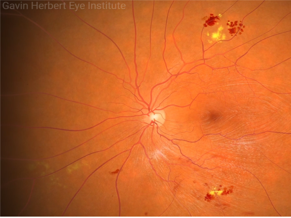 Retina Photo