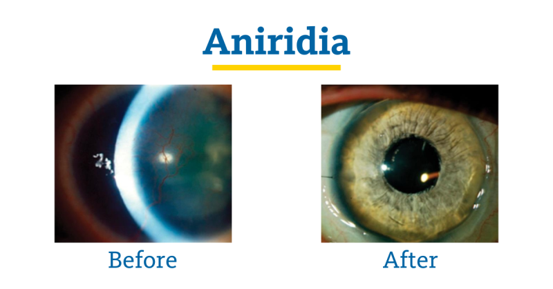 Aniridia Before and After