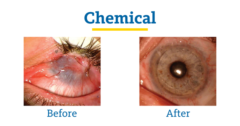 Chemical Burn Before and After