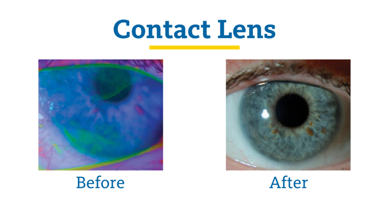 Contact Lens Before and After Photo