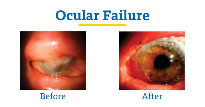 Ocular Failure Before and After