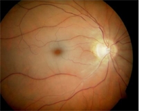 microscopic view of Central Retinal Artery Occlusion (CRAO)